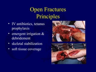 Open Fractures
Principles
• IV antibiotics, tetanus
prophylaxis
• emergent irrigation &
debridement
• skeletal stabilization
• soft tissue coverage
 