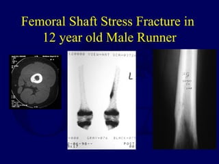 Femoral Shaft Stress Fracture in
12 year old Male Runner
 
