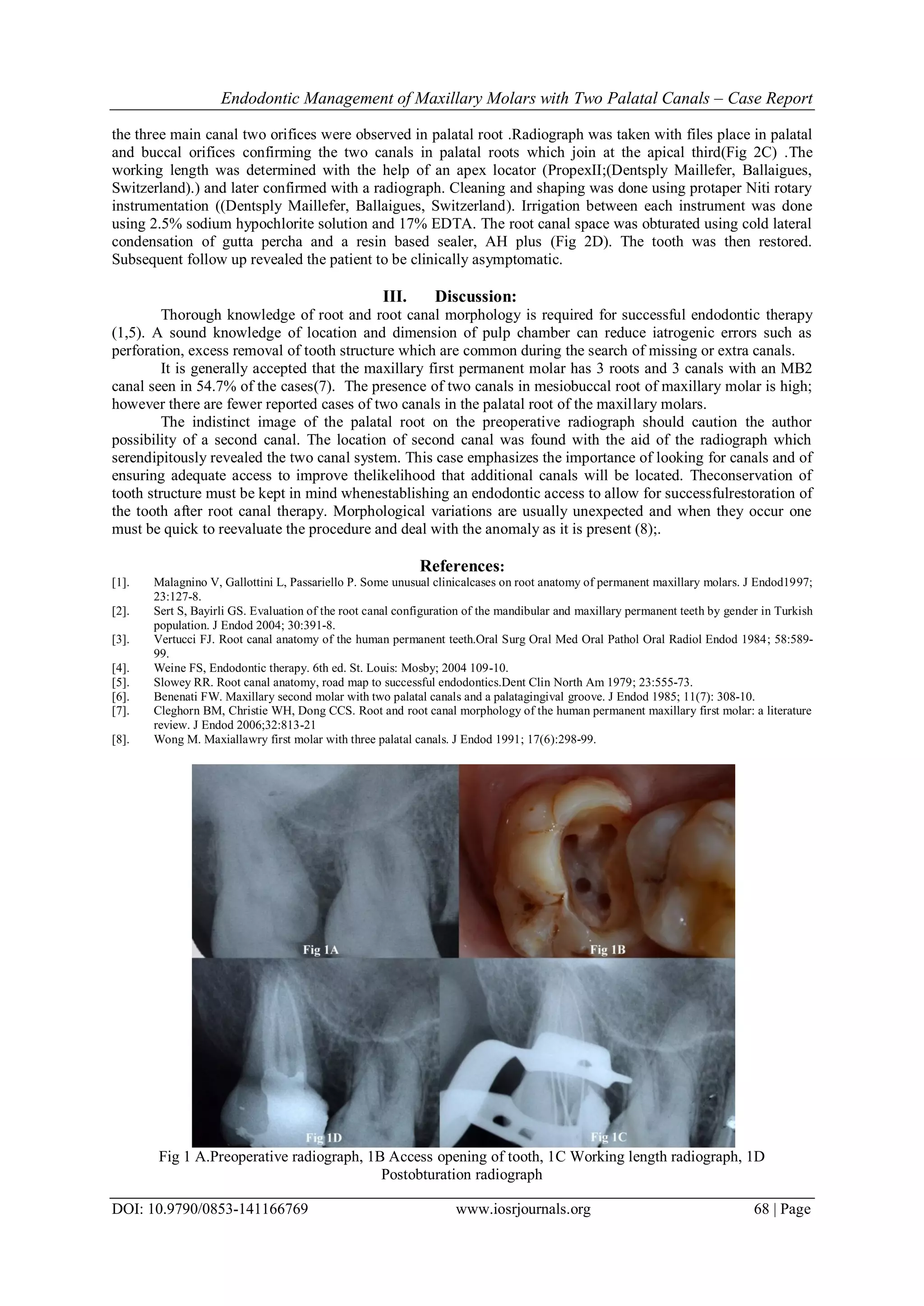 Endodontic Management of Maxillary Molars with Two Palatal Canals ...