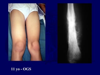 11 yo - OGS
 