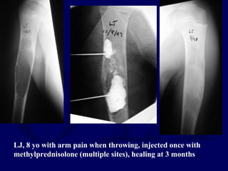 LJ, 8 yo with arm pain when throwing, injected once with
methylprednisolone (multiple sites), healing at 3 months
 