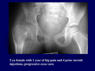 5 yo female with 1 year of hip pain and 4 prior steroid
injections, progressive coxa vara
 