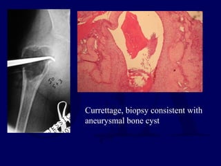 Currettage, biopsy consistent with
aneurysmal bone cyst
 