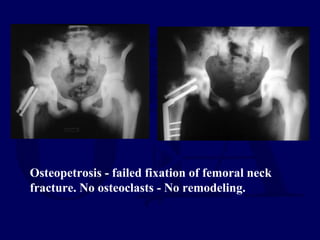 Osteopetrosis - failed fixation of femoral neck
fracture. No osteoclasts - No remodeling.
 