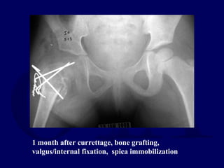 1 month after currettage, bone grafting,
valgus/internal fixation, spica immobilization
 