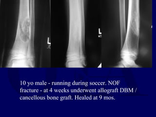 10 yo male - running during soccer. NOF
fracture - at 4 weeks underwent allograft DBM /
cancellous bone graft. Healed at 9 mos.
 