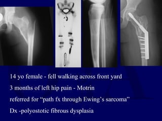 14 yo female - fell walking across front yard
3 months of left hip pain - Motrin
referred for “path fx through Ewing’s sarcoma”
Dx -polyostotic fibrous dysplasia
 