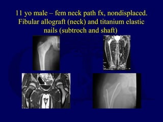 11 yo male – fem neck path fx, nondisplaced.
Fibular allograft (neck) and titanium elastic
nails (subtroch and shaft)
 