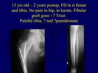 13 yrs old – 2 years postop. FD in rt femur
and tibia. No pain in hip, in karate. Fibular
graft gone - ? Treat
Painful tibia. ? nail ?pamidronate
 