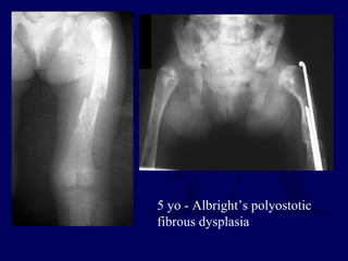 5 yo - Albright’s polyostotic
fibrous dysplasia
 