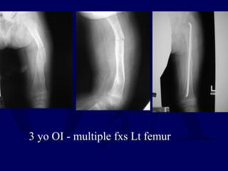 3 yo OI - multiple fxs Lt femur
 
