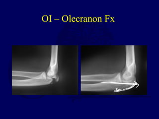 OI – Olecranon Fx
 