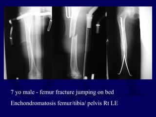 7 yo male - femur fracture jumping on bed
Enchondromatosis femur/tibia/ pelvis Rt LE
 