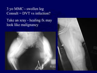 3 yo MMC - swollen leg
Consult = DVT vs infection?
Take an xray - healing fx may
look like malignancy
 