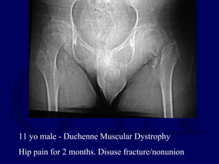 11 yo male - Duchenne Muscular Dystrophy
Hip pain for 2 months. Disuse fracture/nonunion
 
