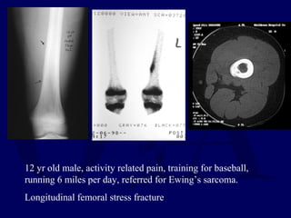 12 yr old male, activity related pain, training for baseball,
running 6 miles per day, referred for Ewing’s sarcoma.
Longitudinal femoral stress fracture
 