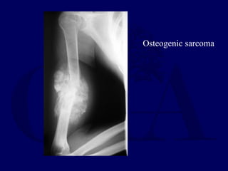 Osteogenic sarcoma
 