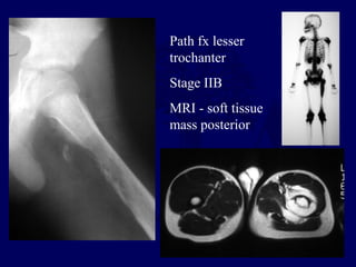 Path fx lesser
trochanter
Stage IIB
MRI - soft tissue
mass posterior
 