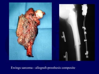 Ewings sarcoma - allograft-prosthesis composite
 