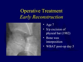 Bar Resection P07 pediatric pelvis, aceta | PPT