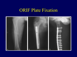 Oref Leg P09 pediatric femur | PPT