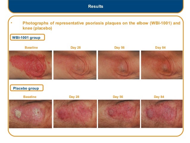 Efficacy and safety of topically applied 1.0 WBI 1001