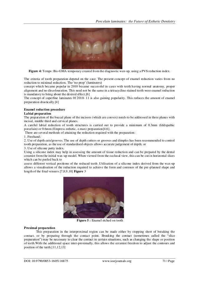 Porcelain laminates the Future of Esthetic Dentistry