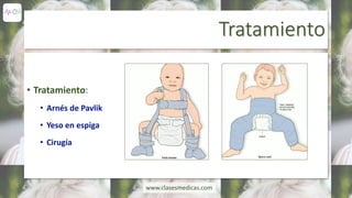 Tratamiento
• Tratamiento:
• Arnés de Pavlik
• Yeso en espiga
• Cirugía
www.clasesmedicas.com
 
