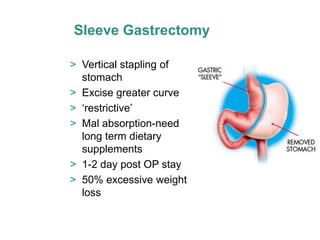 Sleeve Gastrectomy

> Vertical stapling of
  stomach
> Excise greater curve
> ‘restrictive’
> Mal absorption-need
  long term dietary
  supplements
> 1-2 day post OP stay
> 50% excessive weight
  loss
 