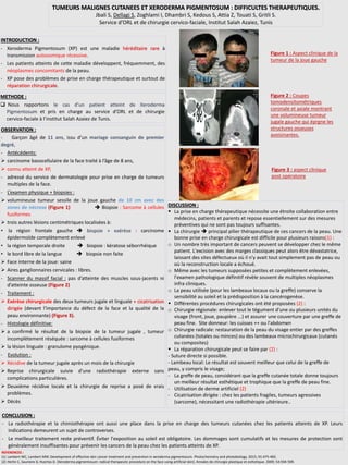 TUMEURS MALIGNES CUTANEES ET XERODERMA PIGMENTOSUM : DIFFICULTES THERAPEUTIQUES.
Jbali S, Dellagi S, Zoghlami I, Dhambri S, Kedous S, Attia Z, Touati S, Gritli S.
Service d’ORL et de chirurgie cervico-faciale, Institut Salah Azaiez, Tunis
INTRODUCTION :
- Xeroderma Pigmentosum (XP) est une maladie héréditaire rare à
transmission autosomique récessive.
- Les patients atteints de cette maladie développent, fréquemment, des
néoplasmes concomitants de la peau.
- XP pose des problèmes de prise en charge thérapeutique et surtout de
réparation chirurgicale.
METHODE :
 Nous rapportons le cas d’un patient atteint de Xeroderma
Pigmentosum et pris en charge au service d’ORL et de chirurgie
cervico-faciale à l’institut Salah Azaiez de Tunis.
OBSERVATION :
- Garçon âgé de 11 ans, issu d’un mariage consanguin de premier
degré,
- Antécédents:
 carcinome basocellulaire de la face traité à l’âge de 8 ans,
 connu atteint de XP,
- adressé du service de dermatologie pour prise en charge de tumeurs
multiples de la face.
- L’examen physique + biopsies :
 volumineuse tumeur sessile de la joue gauche de 10 cm avec des
zones de nécrose (Figure 1)  Biopsie : Sarcome à cellules
fusiformes
 trois autres lésions centimétriques localisées à:
• la région frontale gauche  biopsie + exérèse : carcinome
épidermoïde complètement enlevé
• la région temporale droite  biopsie : kératose séborrhéique
• le bord libre de la langue  biopsie non faite
 Face interne de la joue: saine
 Aires ganglionnaires cervicales : libres.
- Scanner du massif facial : pas d’atteinte des muscles sous-jacents ni
d’atteinte osseuse (Figure 2)
- Traitement :
 Exérèse chirurgicale des deux tumeurs jugale et linguale + cicatrisation
dirigée (devant l'importance du défect de la face et la qualité de la
peau environnante) (Figure 3).
- Histologie définitive:
 a confirmé le résultat de la biopsie de la tumeur jugale , tumeur
incomplètement réséquée : sarcome à cellules fusiformes
 la lésion linguale : granulome pyogénique.
- Evolution :
 Récidive de la tumeur jugale après un mois de la chirurgie
 Reprise chirurgicale suivie d’une radiothérapie externe sans
complications particulières.
 Deuxième récidive locale et la chirurgie de reprise a posé de vrais
problèmes.
 Décès
CONCLUSION :
- La radiothérapie et la chimiothérapie ont aussi une place dans la prise en charge des tumeurs cutanées chez les patients atteints de XP. Leurs
indications demeurent un sujet de controverses.
- Le meilleur traitement reste préventif. Éviter l'exposition au soleil est obligatoire. Les dommages sont cumulatifs et les mesures de protection sont
généralement insuffisantes pour prévenir les cancers de la peau chez les patients atteints de XP.
Figure 1 : Aspect clinique de la
tumeur de la joue gauche
Figure 2 : Coupes
tomodensitométriques
coronale et axiale montrant
une volumineuse tumeur
jugale gauche qui éprgne les
structures osseuses
avoisinantes.
Figure 3 : aspect clinique
post opératoire
DISCUSSION :
 La prise en charge thérapeutique nécessite une étroite collaboration entre
médecins, patients et parents et repose essentiellement sur des mesures
préventives qui ne sont pas toujours suffisantes.
 La chirurgie  principal pilier thérapeutique de ces cancers de la peau. Une
bonne prise en charge chirurgicale est difficile pour plusieurs raisons(1) :
o Un nombre très important de cancers peuvent se développer chez le même
patient. L'excision avec des marges classiques peut alors être dévastatrice,
laissant des sites défectueux où il n'y avait tout simplement pas de peau ou
où la reconstruction locale a échoué.
o Même avec les tumeurs supposées petites et complètement enlevées,
l'examen pathologique définitif révèle souvent de multiples néoplasmes
infra cliniques.
o La peau utilisée (pour les lambeaux locaux ou la greffe) conserve la
sensibilité au soleil et la prédisposition à la cancérogenèse.
 Différentes procédures chirurgicales ont été proposées (2) :
o Chirurgie régionale: enlever tout le tégument d'une ou plusieurs unités du
visage (front, joue, paupière ...) et assurer une couverture par une greffe de
peau fine. Site donneur: les cuisses ++ ou l'abdomen
o Chirurgie radicale: restauration de la peau du visage entier par des greffes
cutanées (totales ou minces) ou des lambeaux microchirurgicaux (cutanés
ou composites)
 La réparation chirurgicale peut se faire par (2) :
- Suture directe si possible.
- Lambeau local: Le résultat est souvent meilleur que celui de la greffe de
peau, y compris le visage;
- La greffe de peau, considérant que la greffe cutanée totale donne toujours
un meilleur résultat esthétique et trophique que la greffe de peau fine.
- Utilisation de derme artificiel (2)
- Cicatrisation dirigée : chez les patients fragiles, tumeurs agressives
(sarcome), nécessitant une radiothérapie ultérieure..
REFERENCES :
(1) Lambert WC, Lambert MW. Development of effective skin cancer treatment and prevention in xeroderma pigmentosum. Photochemistry and photobiology. 2015; 91:475-483.
(2) Herlin C, Sauniere D, Huertas D. [Xeroderma pigmentosum: radical therapeutic procedure on the face using artificial skin]. Annales de chirurgie plastique et esthetique. 2009; 54:594-599.
 