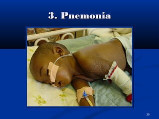 3. Pnemonia3. Pnemonia
20
 