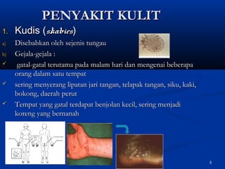 PENYAKIT KULITPENYAKIT KULIT
1.1. Kudis (Kudis (skabiesskabies))
a)a) Disebabkan oleh sejenis tungauDisebabkan oleh sejenis tungau
b)b) Gejala-gejala :Gejala-gejala :
 gatal-gatal terutama pada malam hari dan mengenai beberapagatal-gatal terutama pada malam hari dan mengenai beberapa
orang dalam satu tempatorang dalam satu tempat
 sering menyerang lipatan jari tangan, telapak tangan, siku, kaki,sering menyerang lipatan jari tangan, telapak tangan, siku, kaki,
bokong, daerah perutbokong, daerah perut
 Tempat yang gatal terdapat benjolan kecil, sering menjadiTempat yang gatal terdapat benjolan kecil, sering menjadi
koreng yang bernanahkoreng yang bernanah
3
 