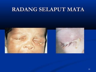 RADANG SELAPUT MATARADANG SELAPUT MATA
31
 