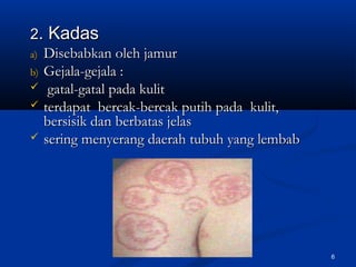 22. Kadas. Kadas
a)a) Disebabkan oleh jamurDisebabkan oleh jamur
b)b) Gejala-gejala :Gejala-gejala :
 gatal-gatal pada kulitgatal-gatal pada kulit
 terdapat bercak-bercak putih pada kulit,terdapat bercak-bercak putih pada kulit,
bersisik dan berbatas jelasbersisik dan berbatas jelas
 sering menyerang daerah tubuh yang lembabsering menyerang daerah tubuh yang lembab
6
 