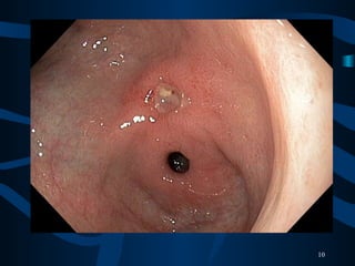 • Gambaran ulkus endoskopi
10
 