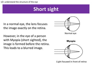 Short sight
In a normal eye, the lens focuses
the image exactly on the retina.
However, in the eye of a person
with Myopia (short sighted), the
image is formed before the retina.
This leads to a blurred image.
LO: understand the structure of the eye
 