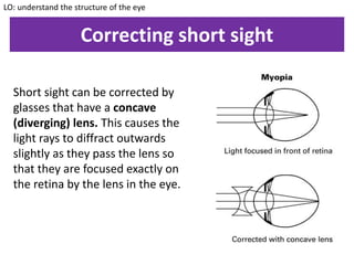 Correcting short sight
Short sight can be corrected by
glasses that have a concave
(diverging) lens. This causes the
light rays to diffract outwards
slightly as they pass the lens so
that they are focused exactly on
the retina by the lens in the eye.
LO: understand the structure of the eye
 