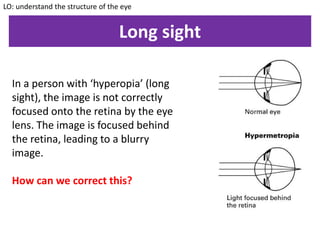 Long sight
In a person with ‘hyperopia’ (long
sight), the image is not correctly
focused onto the retina by the eye
lens. The image is focused behind
the retina, leading to a blurry
image.
How can we correct this?
LO: understand the structure of the eye
 