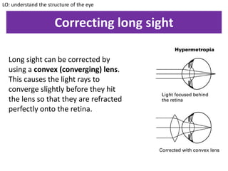 Correcting long sight
Long sight can be corrected by
using a convex (converging) lens.
This causes the light rays to
converge slightly before they hit
the lens so that they are refracted
perfectly onto the retina.
LO: understand the structure of the eye
 