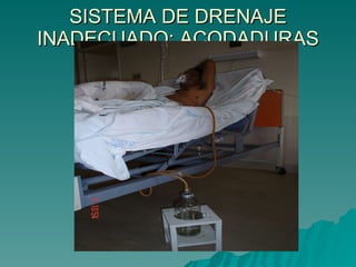 SISTEMA DE DRENAJE INADECUADO: ACODADURAS 