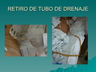 RETIRO DE TUBO DE DRENAJE 