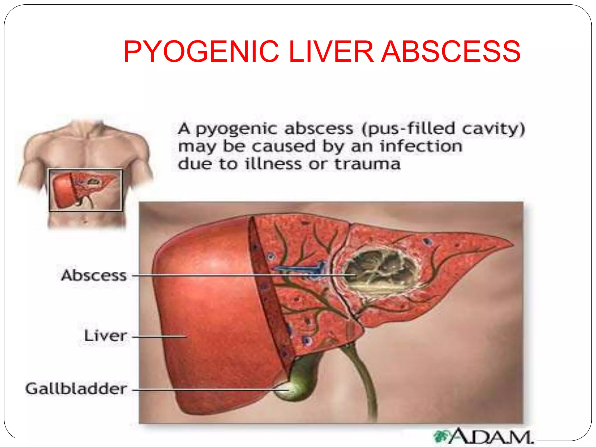 Liver Abscesses Algorithm Liver abscess 1 | PPTX