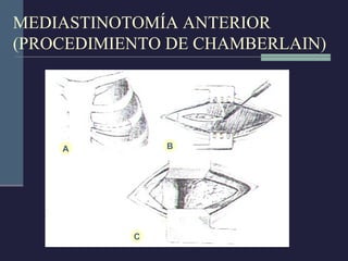 Incisiones toracicas | PPT