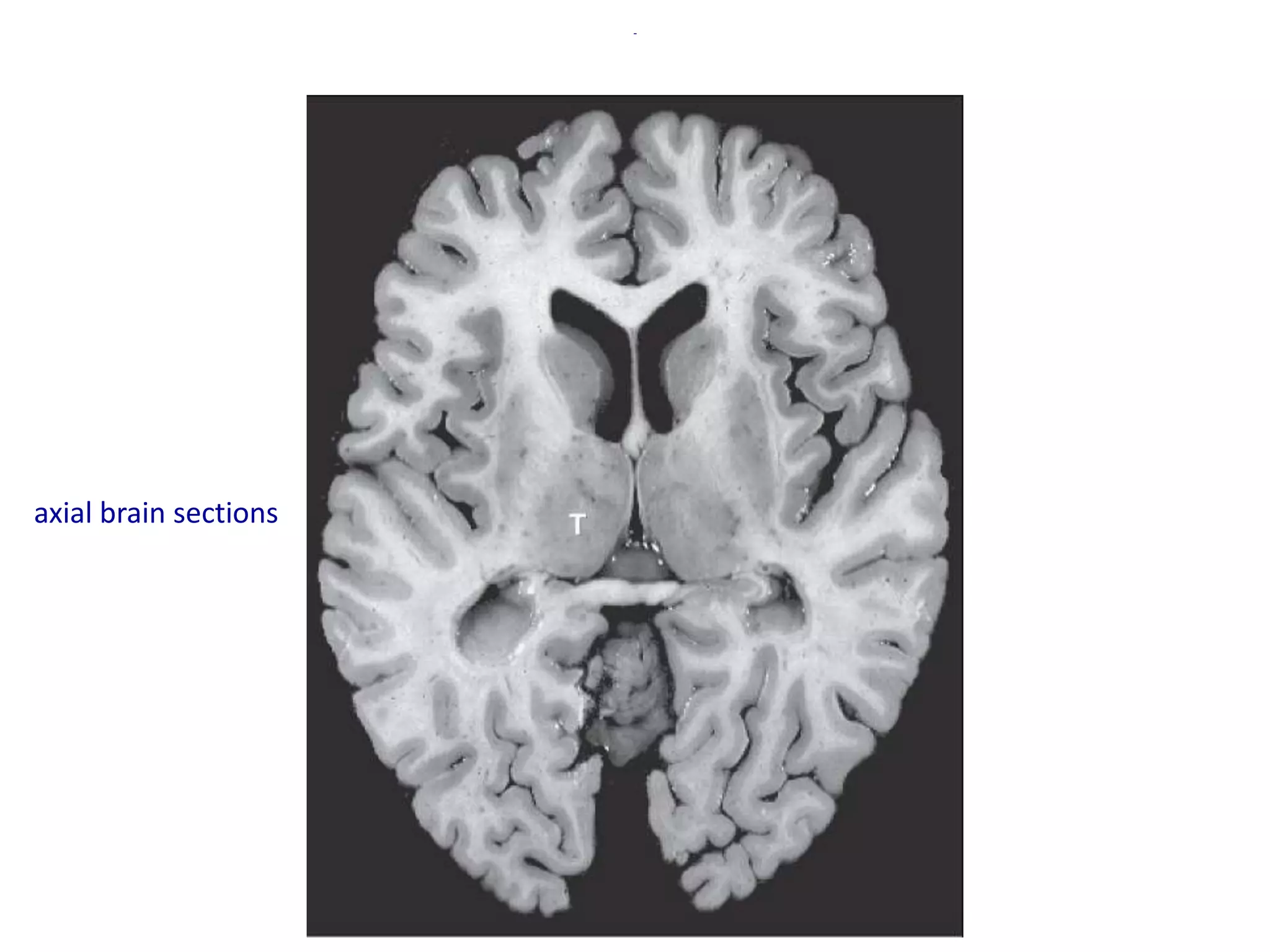 -
axial brain sections
 