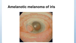 Myomas and myosarcomas
Leiomyoma can arise from the smooth muscle of the iris and
ciliary body. The malignant form leiomyo...