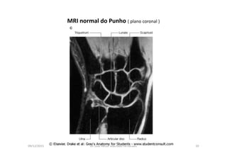 09/12/2015 Dr. José Heitor Machado Fernandes 10
MRI normal do Punho ( plano coronal )
 