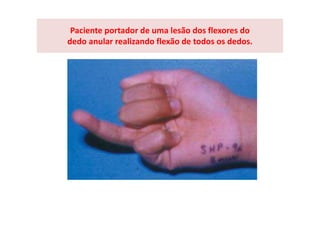 Paciente portador de uma lesão dos flexores do
dedo anular realizando flexão de todos os dedos.
 
