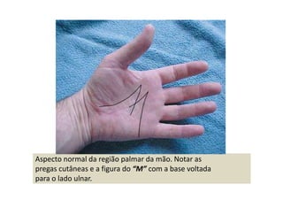 Aspecto normal da região palmar da mão. Notar as
pregas cutâneas e a figura do “M” com a base voltada
para o lado ulnar.
 
