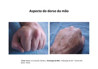 Aspecto do dorso da mão
Fonte: Mattar Jr.,R; Azze,RJ; Falcetti,J; Semiologia da Mão – Publicação do IOT – Famed USP ,
Searle - Phizer
 