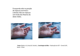 À esquerda mão na posição
de repouso (normal) e
à direita mão em repouso
com lesão dos flexores do
dedo médio.
Fonte: Mattar Jr.,R; Azze,RJ; Falcetti,J; Semiologia da Mão – Publicação do IOT – Famed USP ,
Searle - Phizer
 